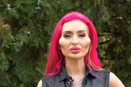 Tiêm filler quá đà, người mẫu Ukraine khiến người nhìn “dựng tóc gáy“