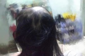 Cứ stress là nhổ tóc, cô gái nhận cái kết khiến dân mạng "hoảng hồn"