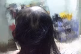 Cứ stress là nhổ tóc, cô gái nhận cái kết khiến dân mạng "hoảng hồn"