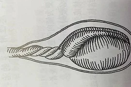 Cậu bé phải cắt bỏ tinh hoàn do bị xoắn