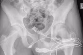 Đo thử “cậu nhỏ”, thiếu niên 15 tuổi nhập viện khẩn cẩp