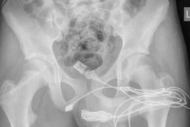 Đo thử “cậu nhỏ”, thiếu niên 15 tuổi nhập viện khẩn cẩp