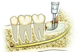Tại sao không thể nhổ hết răng khôn cùng một lúc?