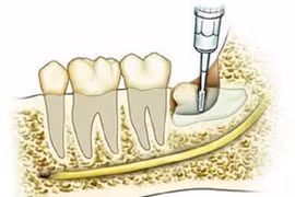 Tại sao không thể nhổ hết răng khôn cùng một lúc?