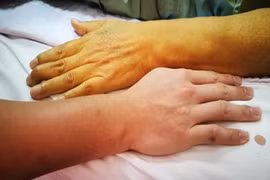 7 dấu hiệu gan của bạn đang kêu cứu, có 1 cũng không được chủ quan