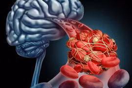 Người đàn ông 50 tuổi liệt nửa đêm vì nhồi máu não