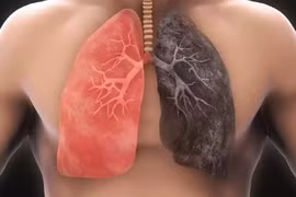 Những quan niệm sai lầm thường gặp về ung thư phổi