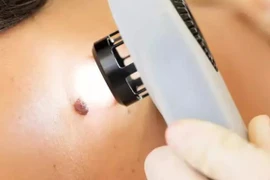 Vùng nào trên cơ thể dễ bị ung thư da nhất?