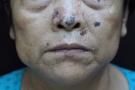 Ung thư thường gặp nhất ở người già với biểu hiện rất quen thuộc