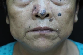 Ung thư thường gặp nhất ở người già với biểu hiện rất quen thuộc