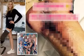 Bà mẹ 5 con bị mất chân sau khi nhiễm bọ ăn thịt