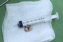 Tím tái vì răng giả rơi vào đường thở trong lúc đang ngủ