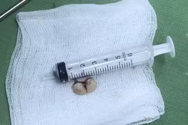 Tím tái vì răng giả rơi vào đường thở trong lúc đang ngủ