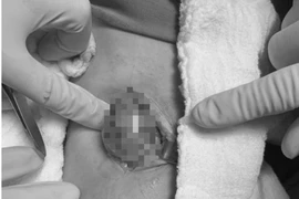 Bác sĩ bóc tách, lấy khối u ra khỏi khoeo chân cho bệnh nhân