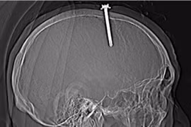 Người đàn ông tự đóng cây đinh dài 5 cm vào đầu mình