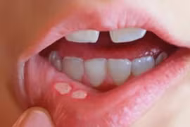 Video: Cách phân biệt nhiệt miệng và ung thư khoang miệng