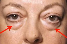 Video: Nguyên nhân nhiều người có “túi mỡ” dưới mắt