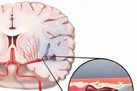 Cách điều trị thiếu máu não hiệu quả