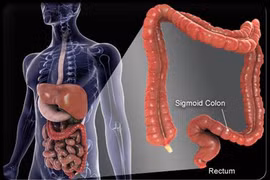 Địa chỉ nào tin cậy cho bệnh nhân ung thư đại tràng?