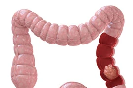 5 loại ung thư gây chết nhiều nhất