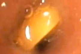 Liên tiếp trẻ nhập viện do hóc dị vật: Cần biết cách xử lý kịp thời