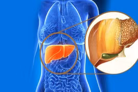 Vì sao người gầy vẫn có nguy cơ mắc gan nhiễm mỡ?