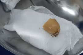 Sau khi ăn sáng với xúc xích, bé gái 13 tuổi nhập viện cấp cứu