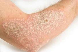 Chế độ dinh dưỡng phù hợp cho người bệnh vảy nến