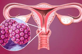 Virus khiến nhiều phụ nữ mắc ung thư cổ tử cung?