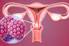 Virus khiến nhiều phụ nữ mắc ung thư cổ tử cung?