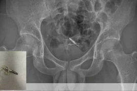 Nhét dây tai nghe vào niệu đạo tìm khoái cảm, nam thanh niên nhận quả đắng