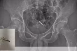 Nhét dây tai nghe vào niệu đạo tìm khoái cảm, nam thanh niên nhận quả đắng