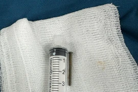 Bé trai 6 tuổi nuốt phải đinh sắt dài 3 cm trong lúc chơi đùa