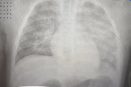 Tưởng sốt ho thông thường, bé 8 tuổi phổi "trắng xóa" sau 6 giờ nhập viện