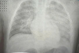 Tưởng sốt ho thông thường, bé 8 tuổi phổi "trắng xóa" sau 6 giờ nhập viện