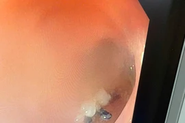 Gắp kim băng sắc nhọn dài 6cm găm trong dạ dày bé trai 2 tuổi