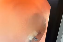 Gắp kim băng sắc nhọn dài 6cm găm trong dạ dày bé trai 2 tuổi