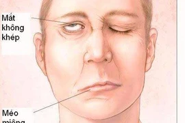 Chủ quan với triệu chứng tê mặt, nam thanh niên bất ngờ bị liệt nửa mặt