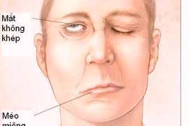 Chủ quan với triệu chứng tê mặt, nam thanh niên bất ngờ bị liệt nửa mặt