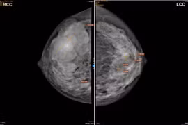 Sờ thấy khối u ở vú phải, đi khám mắc u hiếm gặp