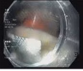 Gắp viên thuốc nguyên vỏ sắc nhọn trong thực quản người đàn ông 67 tuổi