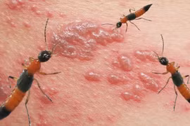 Cần làm gì khi bị kiến ba khoang đốt?