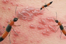 Cần làm gì khi bị kiến ba khoang đốt?