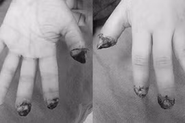 Bé trai 5 tuổi đứt rời 3 ngón tay do máy dập cốc tự động