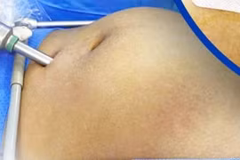 U nang buồng trứng khiến bụng người phụ nữ to như mang thai 4 tháng