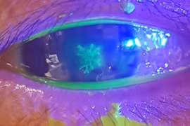 Đau mắt, nhìn mờ, nhỏ thuốc không đỡ, đi khám mắc viêm giác mạc do Herpes