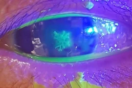 Đau mắt, nhìn mờ, nhỏ thuốc không đỡ, đi khám mắc viêm giác mạc do Herpes