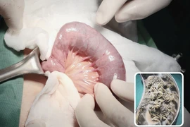 Đau bụng dữ dội kèm theo nôn ói, không ngờ tắc ruột vì bã thức ăn