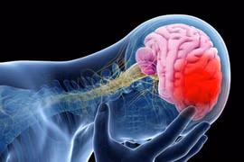 Méo miệng, nói khó... đi khám được chẩn đoán nhồi máu não