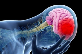 Méo miệng, nói khó... đi khám được chẩn đoán nhồi máu não